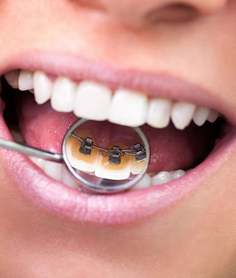 lingual braces