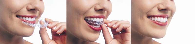 how Invisalign works