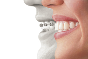 how Invisalign works
