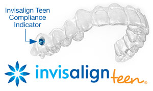 INvisalign teen